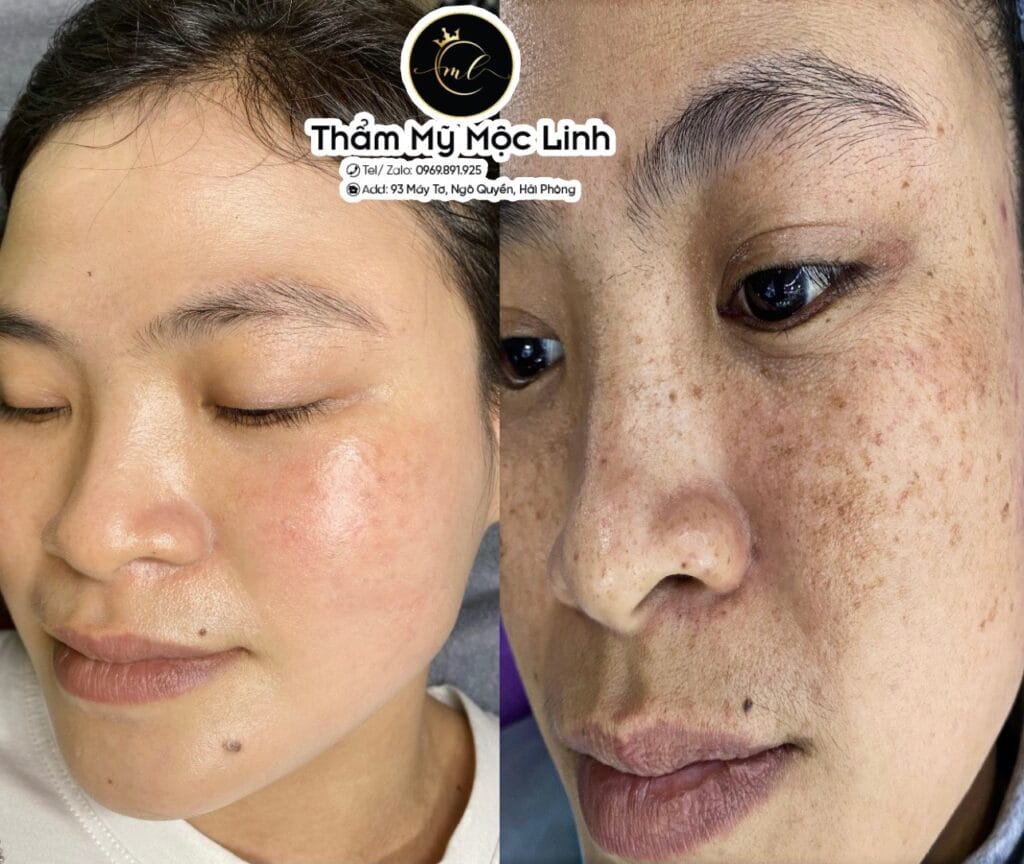 Trị nám/tàn nhang uy tín tại Hải Phòng tại Thẩm Mỹ Mộc Linh - hình 83