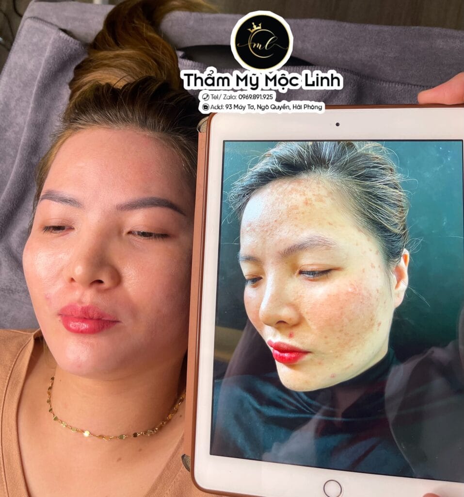 Trị nám/tàn nhang uy tín tại Hải Phòng tại Thẩm Mỹ Mộc Linh - hình 80