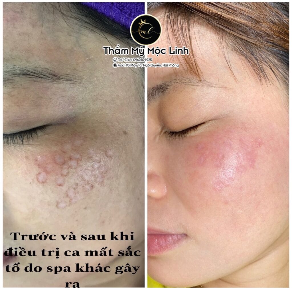 Trị nám/tàn nhang uy tín tại Hải Phòng tại Thẩm Mỹ Mộc Linh - hình 75