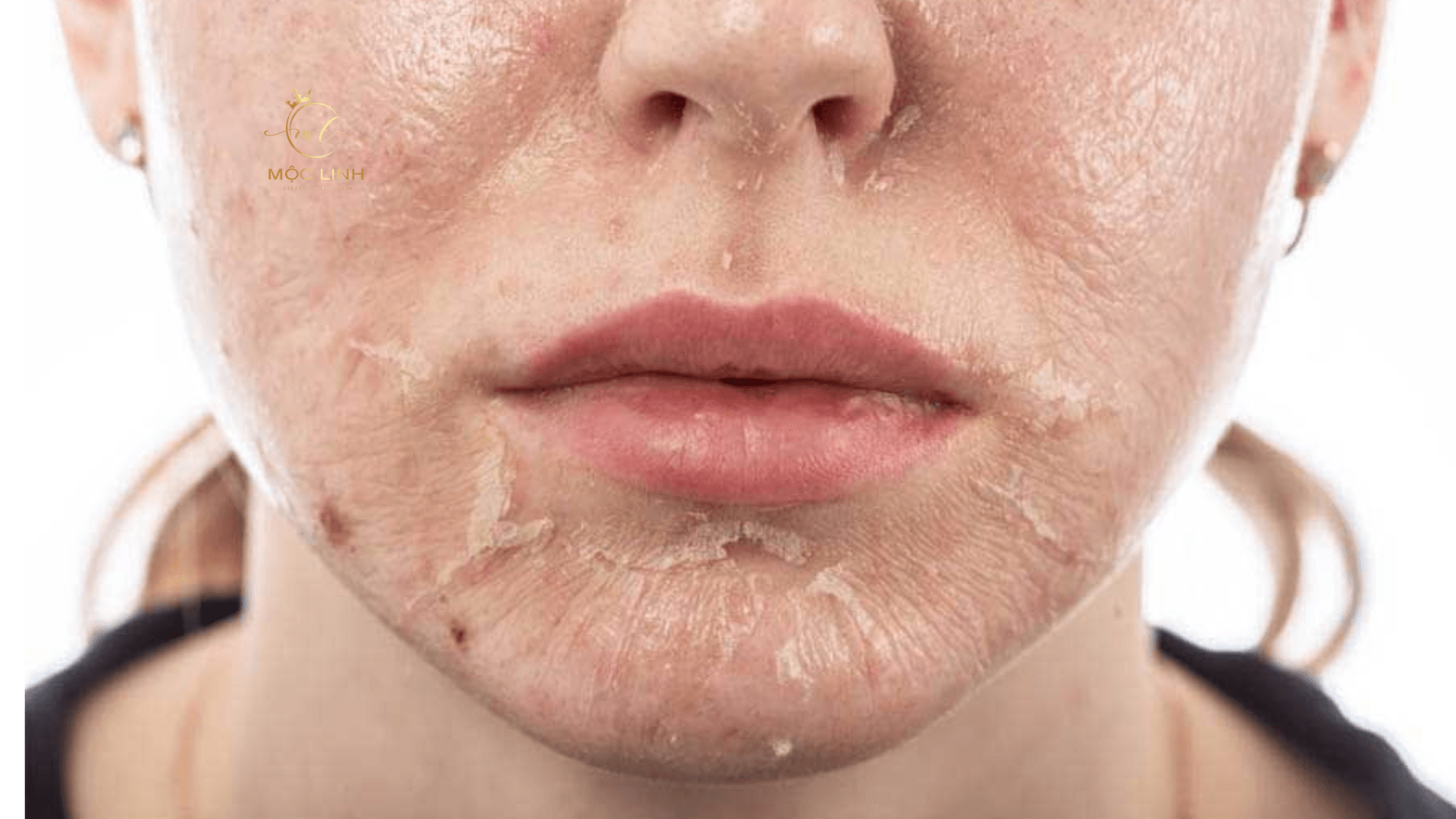 Peel da là gì ? Tác dụng phụ của việc peel da mà bạn tại Thẩm Mỹ Mộc Linh Hải Phòng - hình 2
