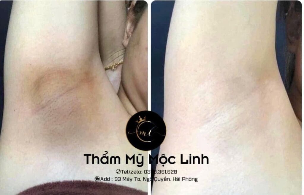 Cách Trị Thâm Nách Đơn Giản, Hiệu Quả Và Nhanh Chóng tại Thẩm Mỹ Mộc Linh Hải Phòng - hình 1