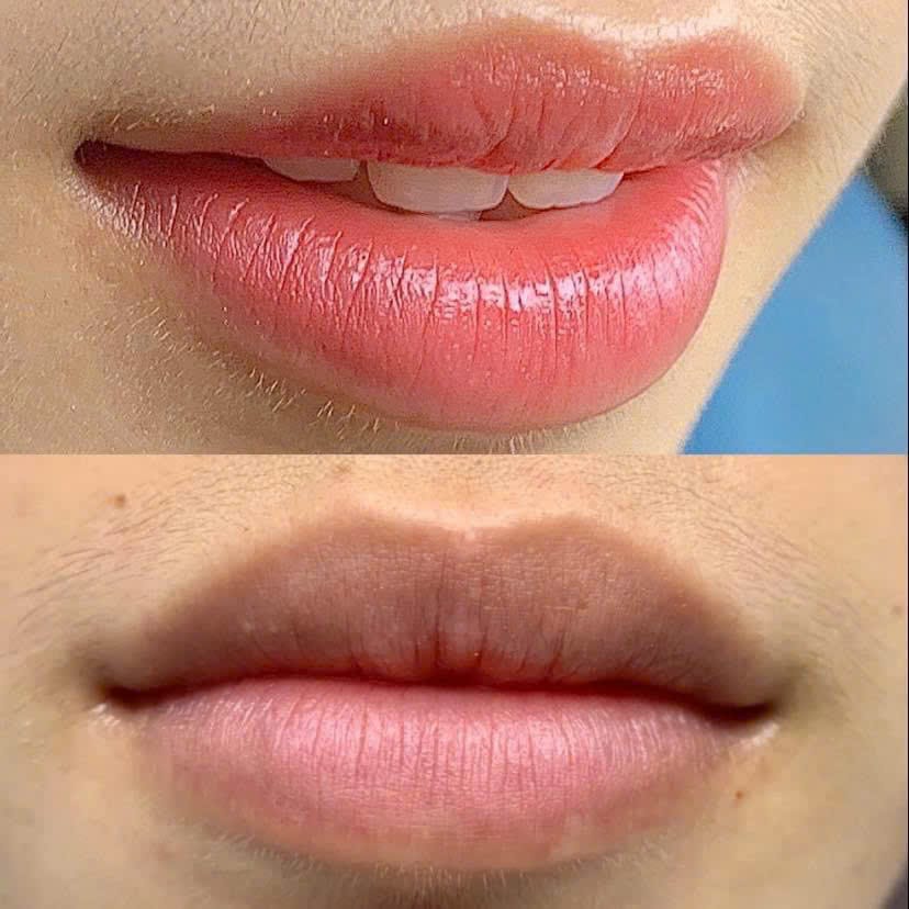 Khử Thâm Môi, Giúp Môi Hồng Hào Tự Nhiên tại Thẩm Mỹ Mộc Linh Hải Phòng - hình 3