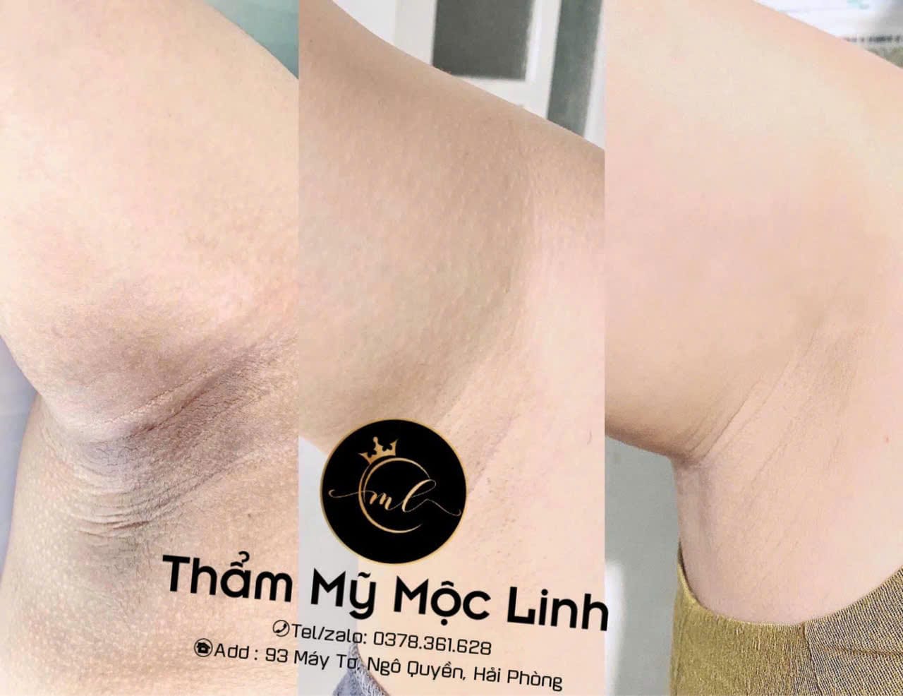 Cách Trị Thâm Nách Đơn Giản, Hiệu Quả Và Nhanh Chóng tại Thẩm Mỹ Mộc Linh Hải Phòng - hình 1