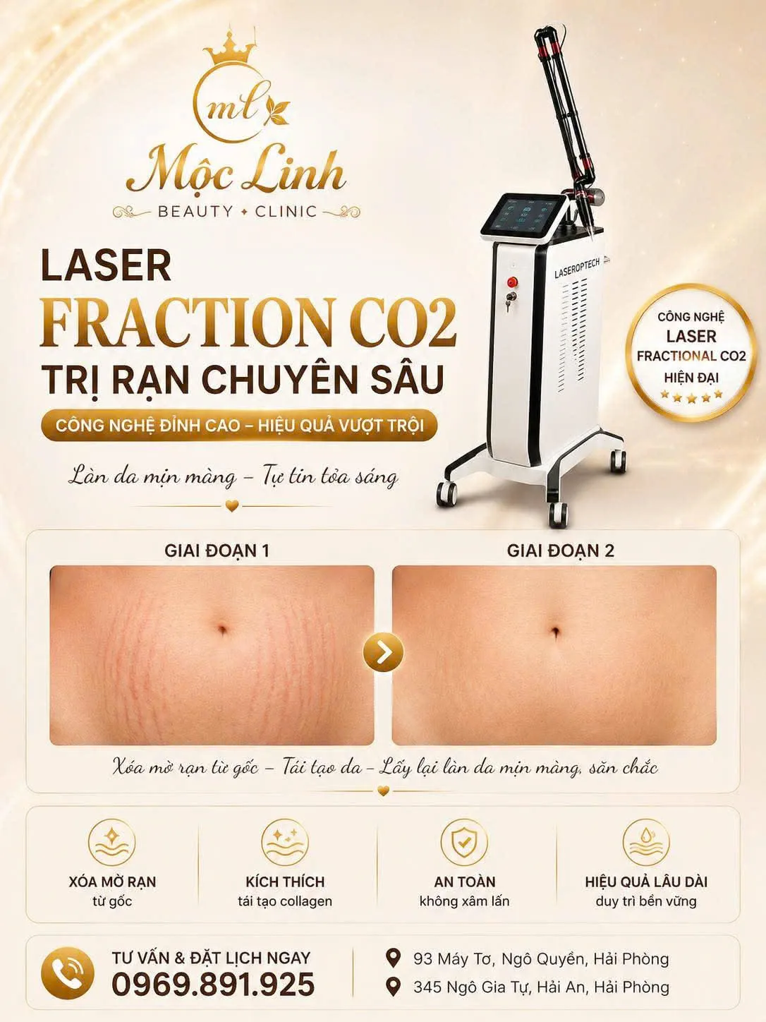 Trị rạn da bằng công nghệ laser tại Thẩm Mỹ Mộc Linh Hải Phòng