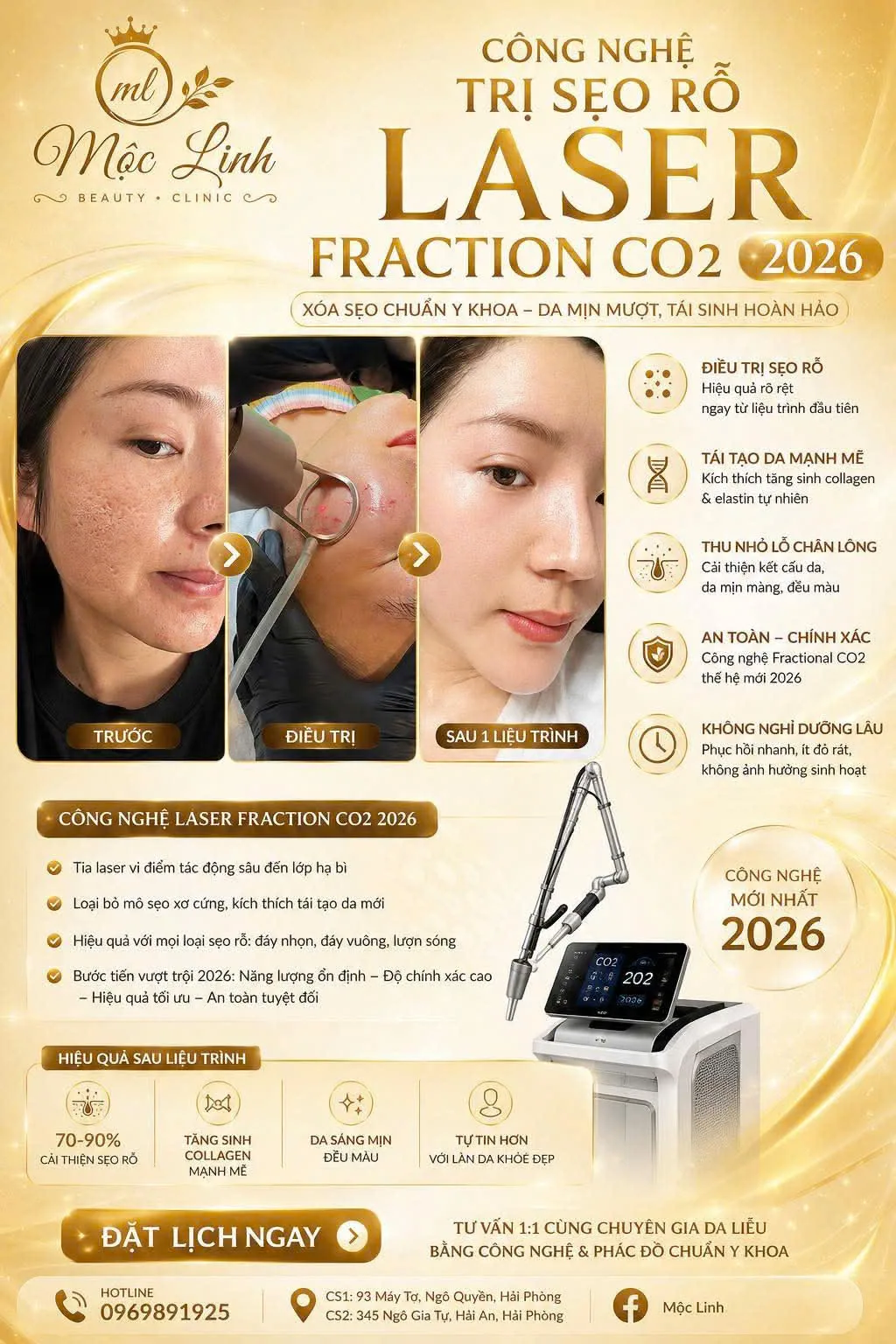 Điều trị sẹo rỗ bằng laser Fractional CO2 tại Thẩm Mỹ Mộc Linh Hải Phòng